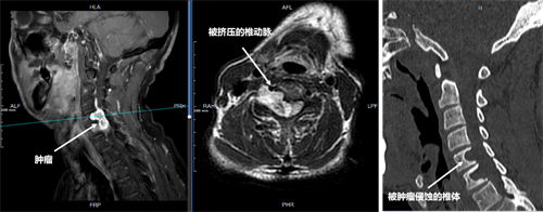 術(shù)前影像可見腫瘤侵蝕多個(gè)椎體，壓迫脊髓及椎動脈.png