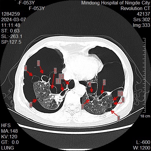 李阿姨肺部CT影像 雙肺多發(fā)囊性病灶.jpg