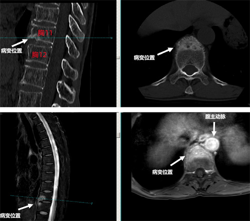 術(shù)前椎體CT及增強(qiáng)MRI檢查提示胸11,12椎體骨破壞.jpg